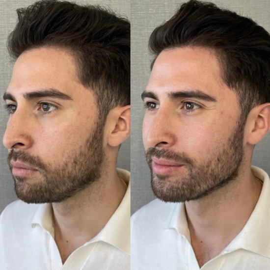 Antes y después MOLDEVA